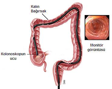 colonoscopy