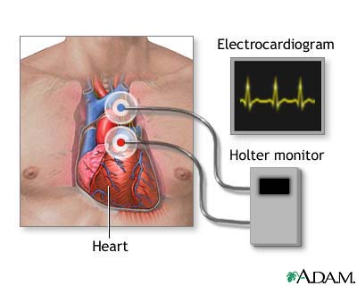 holter-1